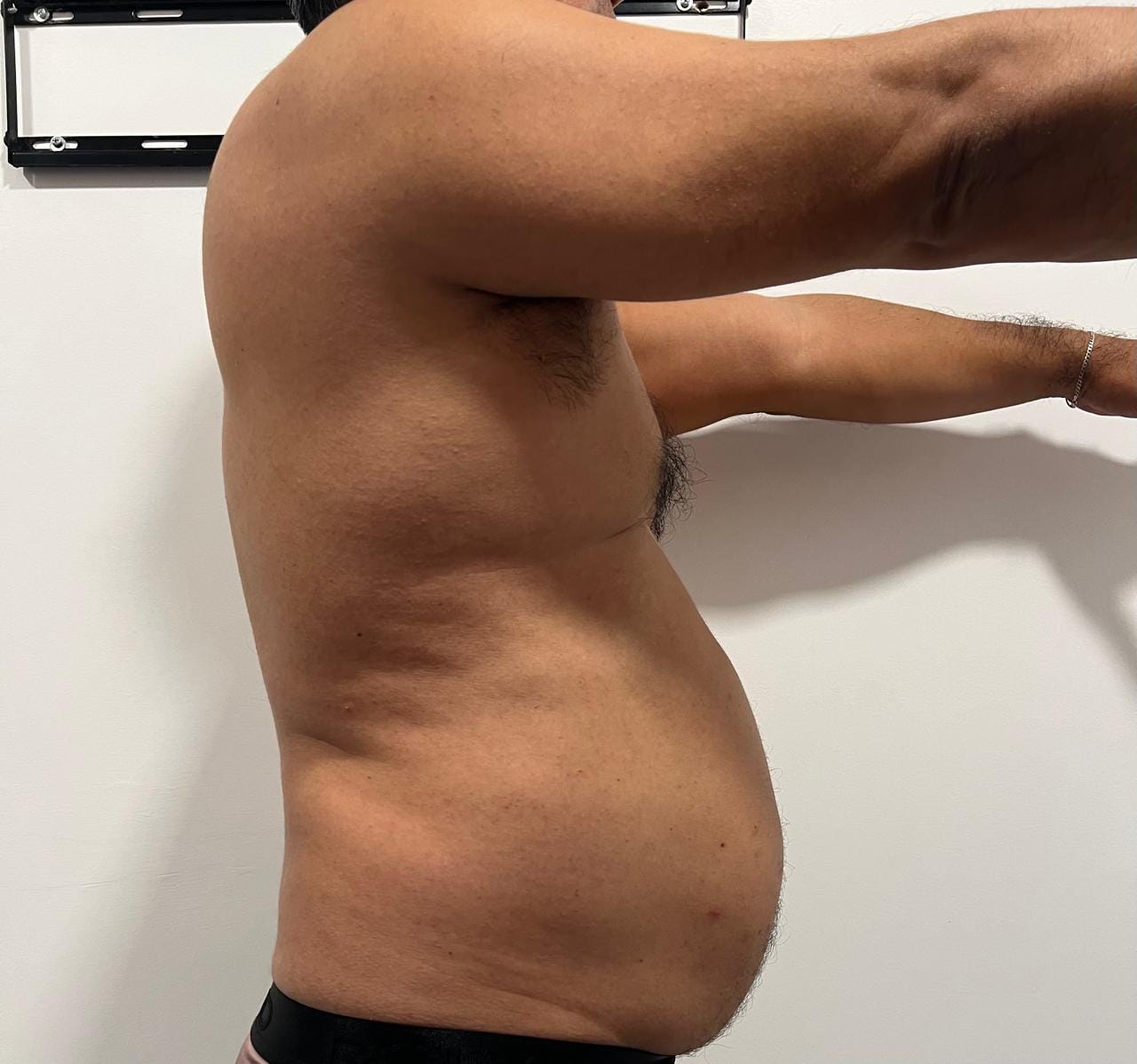 Antes del tratamiento