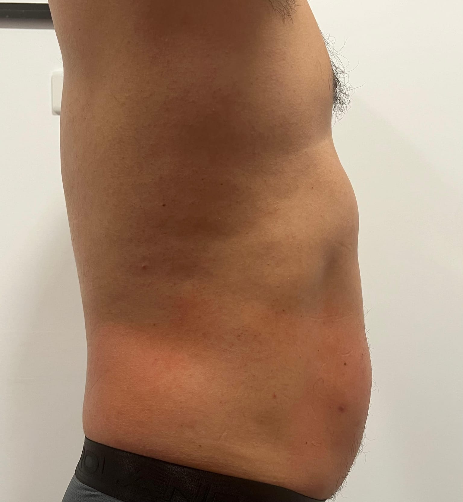 Después del tratamiento