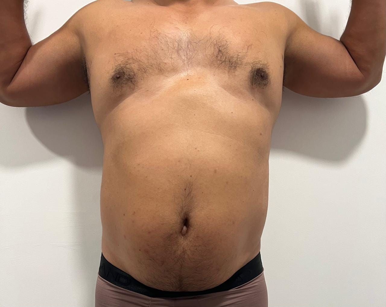 Antes del tratamiento