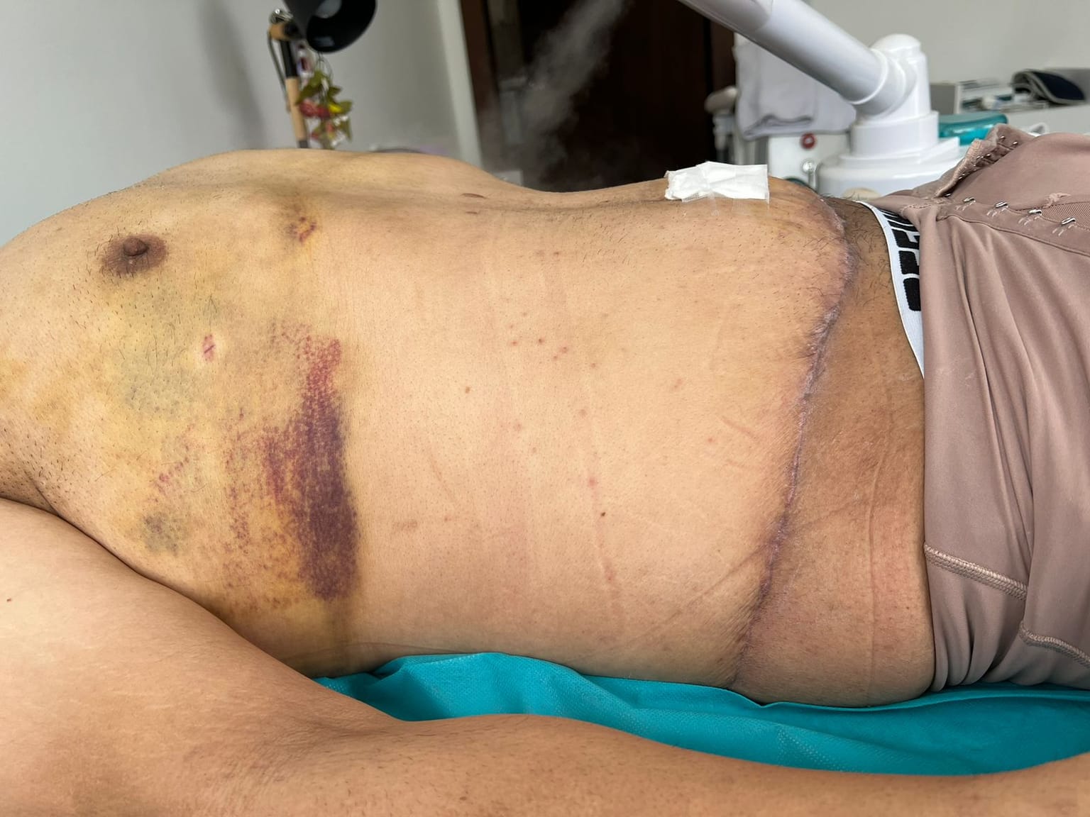 Antes del tratamiento