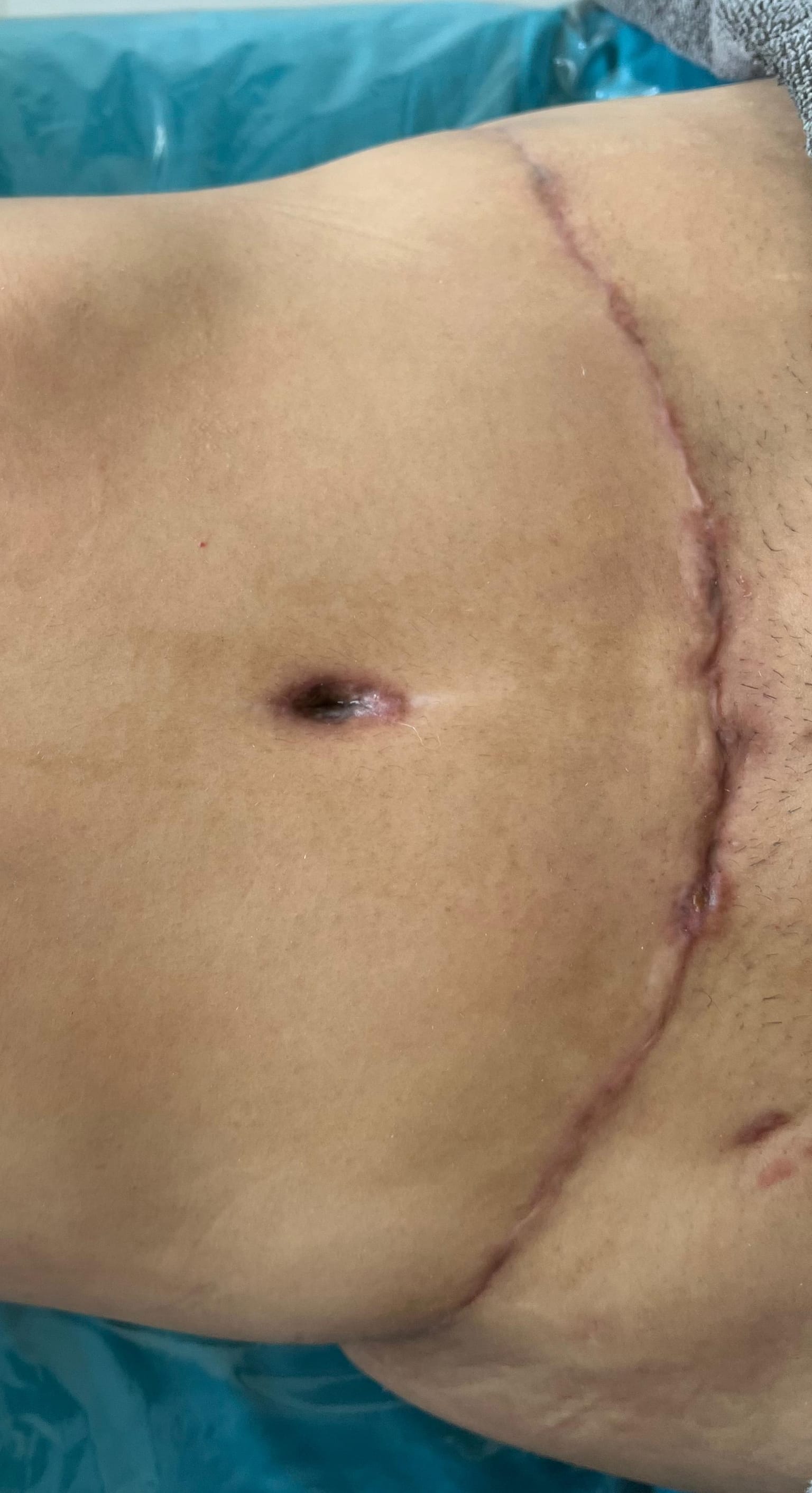 Después del tratamiento