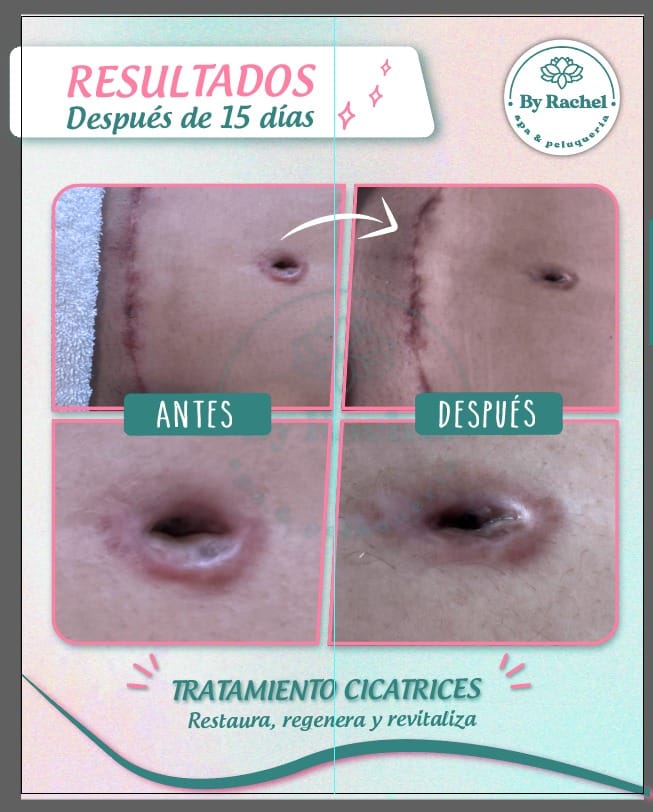 Resultado del tratamiento