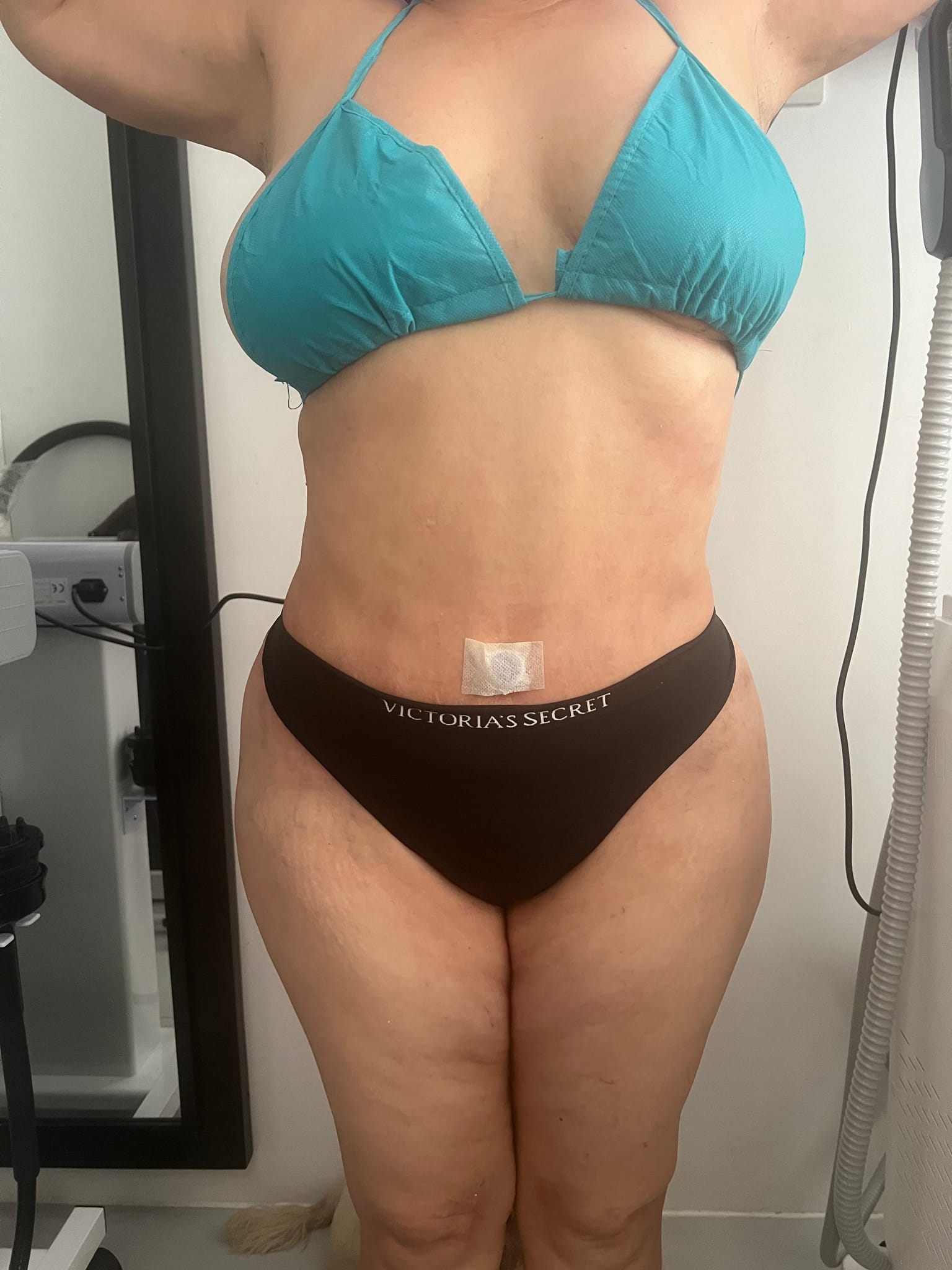 Antes del tratamiento