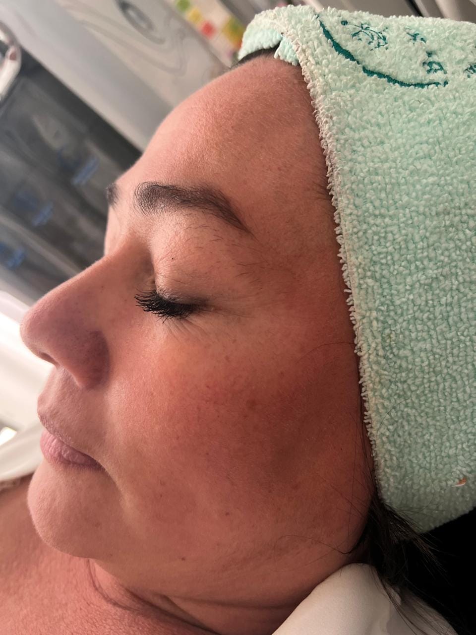 Antes del tratamiento