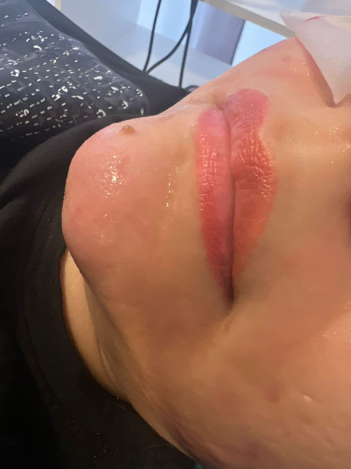 Antes del tratamiento