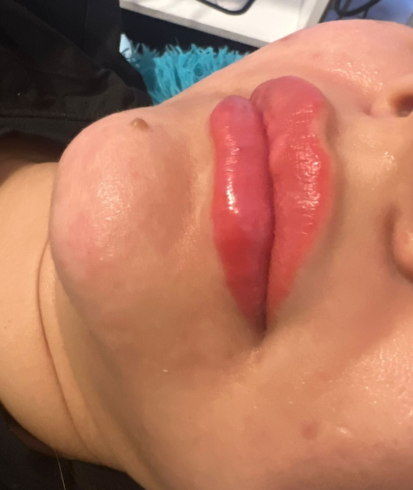 Después del tratamiento